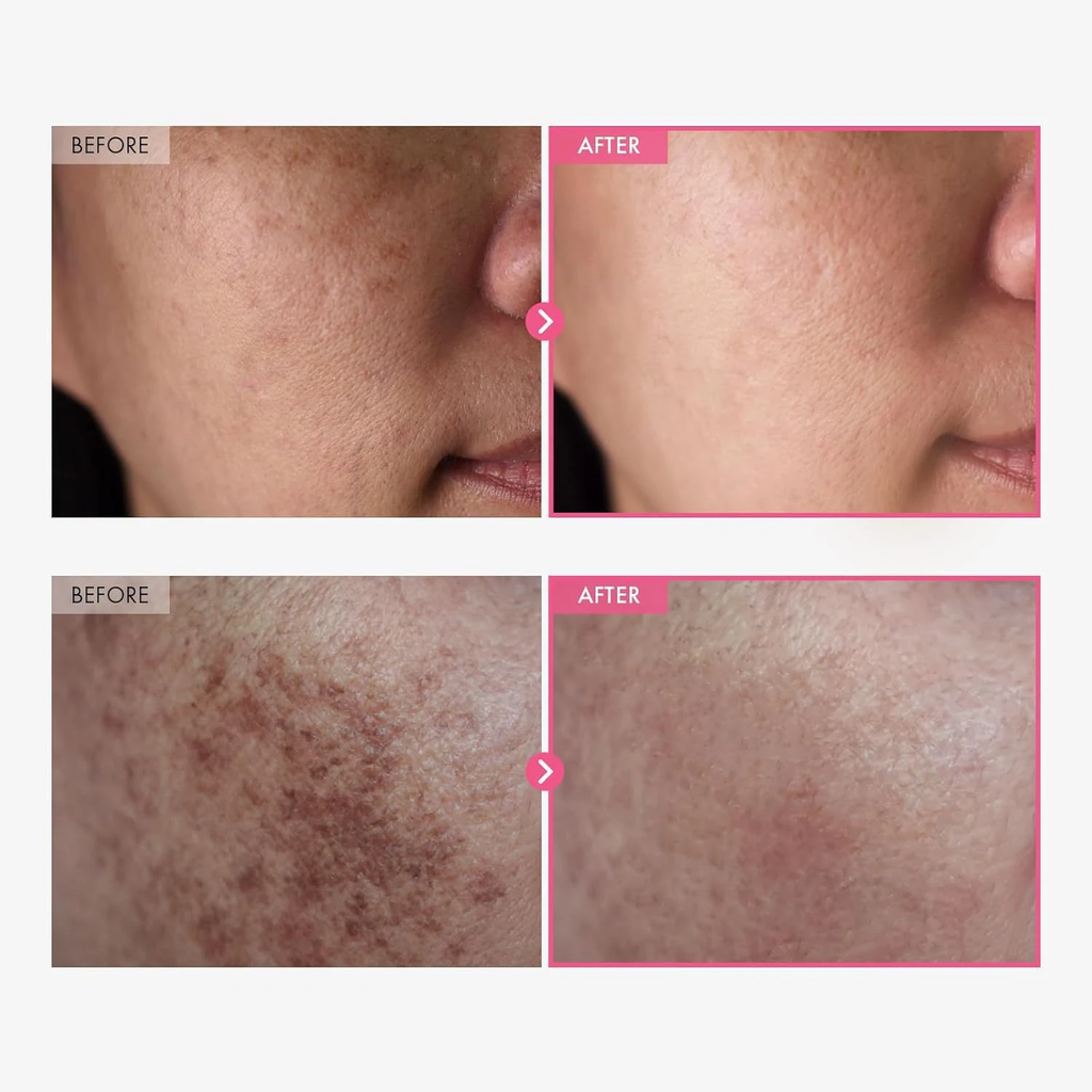 Before and after skin treatment comparison on a person's face.