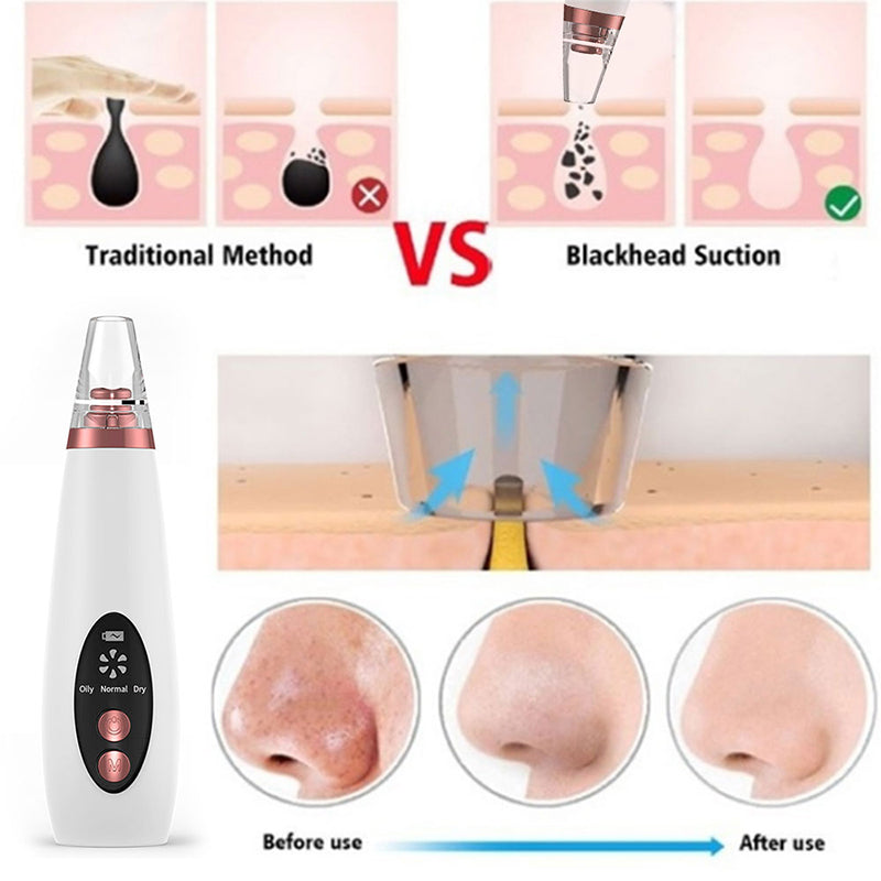 Pro Blackhead Remover Vacuum – Deep Pore Cleaner & Acne Extraction Tool for Clear, Smooth Skin
